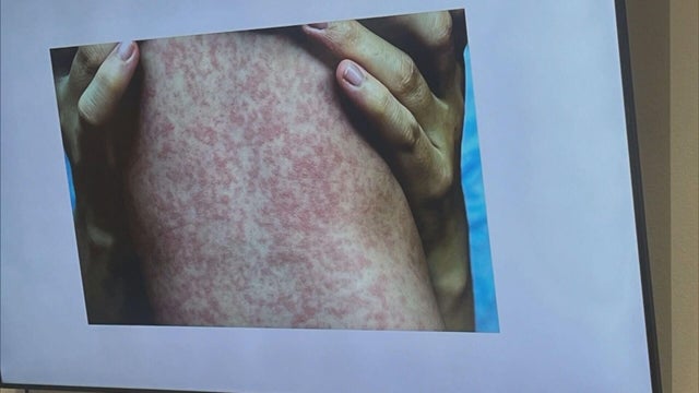 measles-vaccine-5pkg-frame-1477.jpg 
